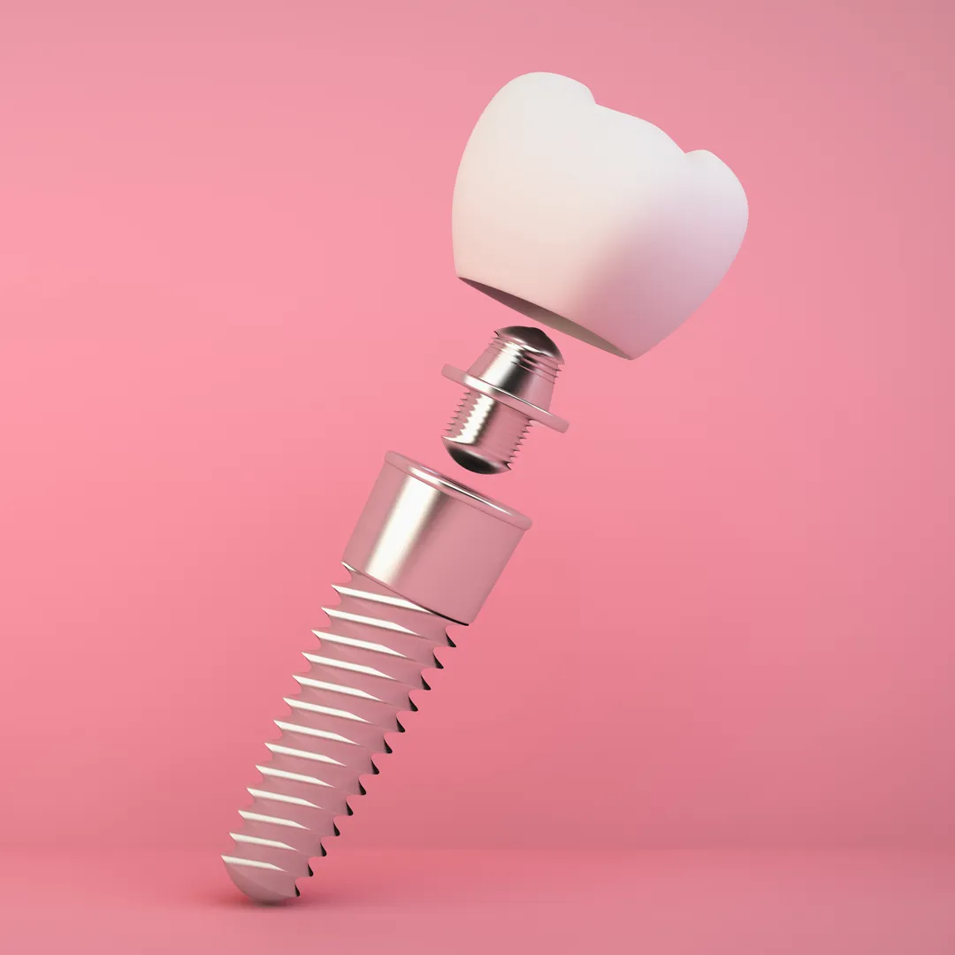implant dentaire dent - Dentisterie Tiraloche