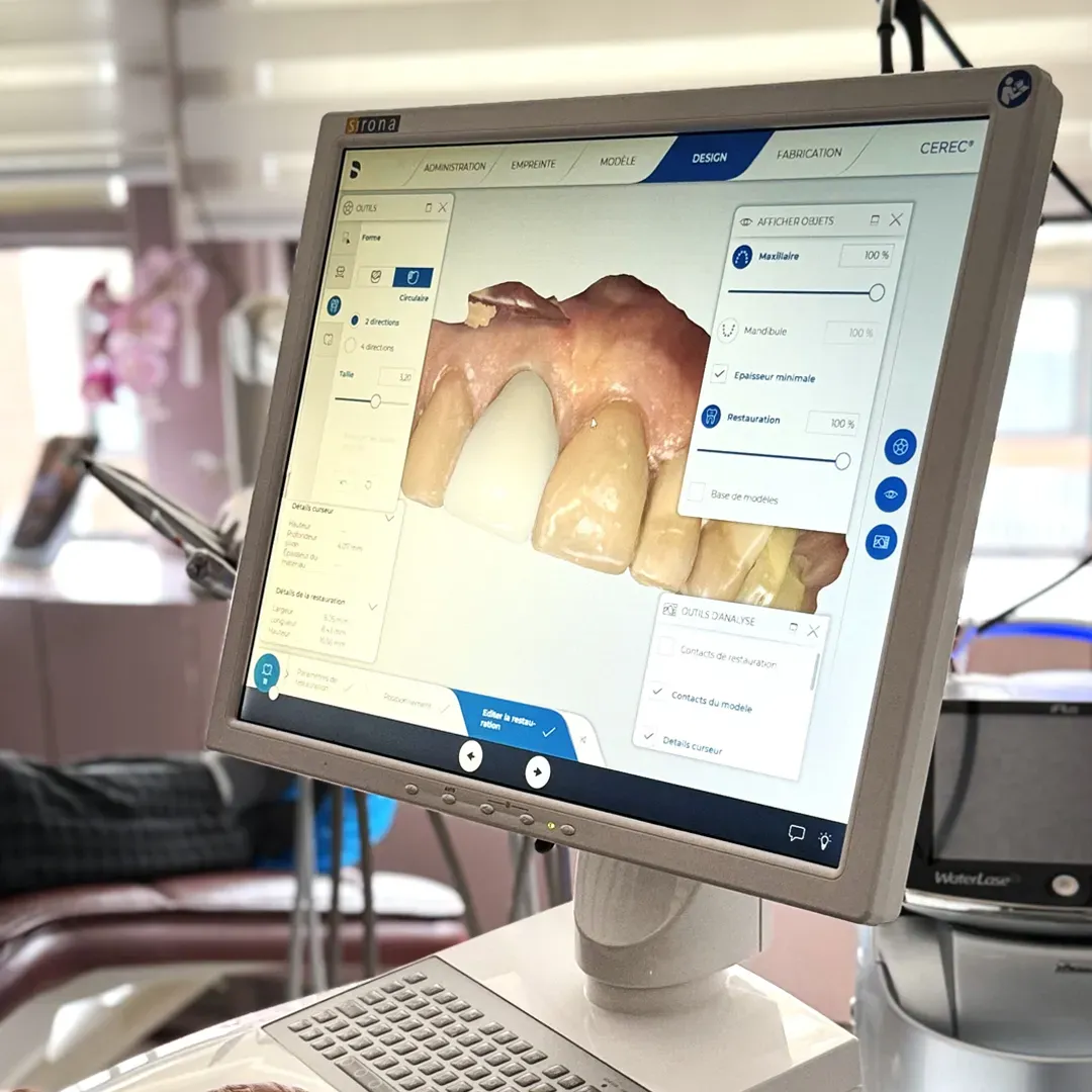 cerec scan 02 - Dentisterie Tiraloche